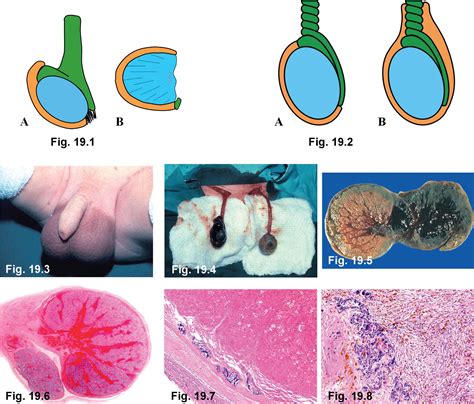 birthdefect where the testes fail to drop|testicle removal after birth.